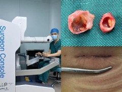 全球首例！江苏省肿瘤医院完成蛇形臂单孔机器人双肾动脉瘤一期切除 + 肾动脉成型术